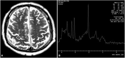 Central nervous system involvement in chronic inflammatory demyelinating polyradiculoneuropathy—MRS and DTI study